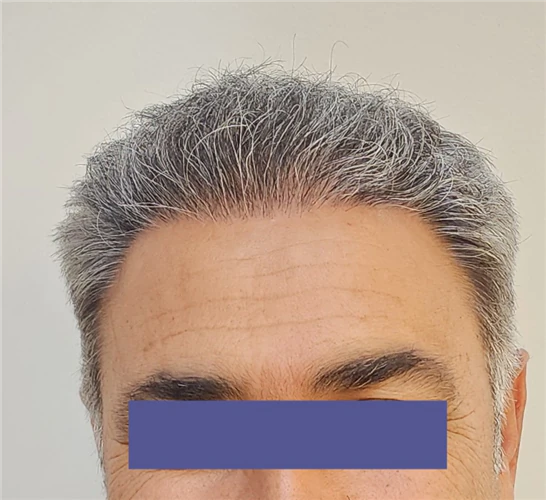 کاشت-مو-و-ابرو-اصفهان